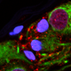 Alpha-synuclein clump in the appendix